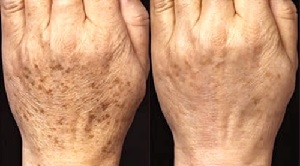 Age Spots Before and After Using Meladerm