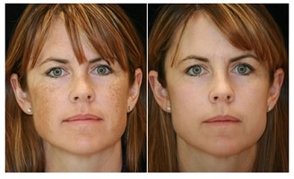 Freckles Before and After Using Meladerm