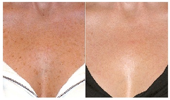 Liver Spots Before and After Using Meladerm
