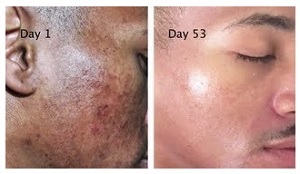Hyperpigmentation Before and After Using Melasma