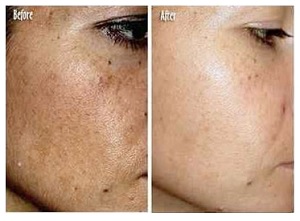 Melasma Befor and After Using Meladerm